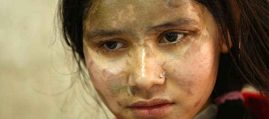 तेजाब आक्रमणमा परेकालाई उपचारकक्षबाटै एसएलसी परिक्षा दिने व्यवस्था